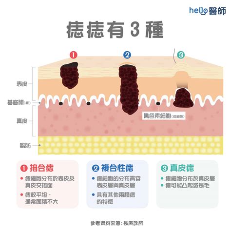 女生長痣|痣形成的原因？痣長毛、痣變多變大是痣病變？5招判。